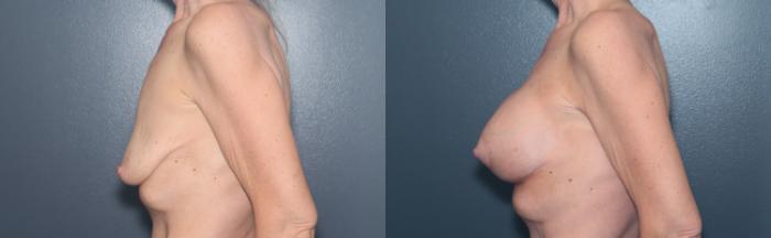 Before & After Breast Augmentation Case 615 Right Side View in West Des Moines & Ames, IA