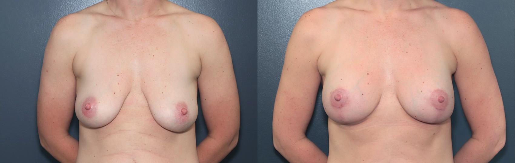 Before & After Breast Augmentation Case 616 Front View in West Des Moines & Ames, IA