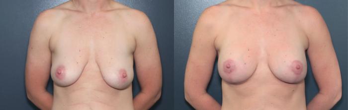 Before & After Breast Augmentation Case 616 Front View in West Des Moines & Ames, IA