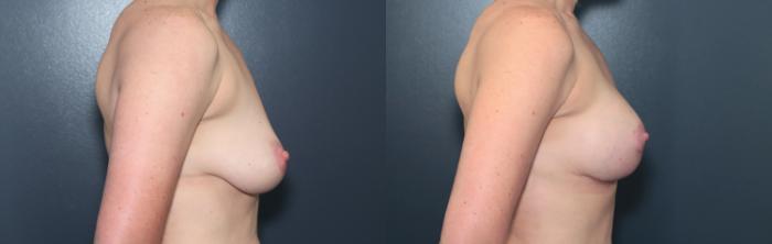 Before & After Breast Augmentation Case 616 Left Side View in West Des Moines & Ames, IA