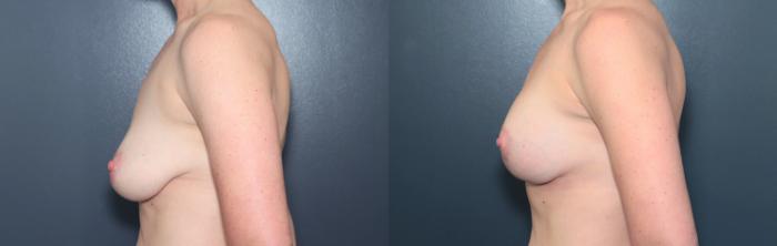 Before & After Breast Augmentation Case 616 Right Side View in West Des Moines & Ames, IA