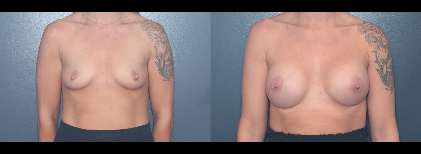 Before & After Breast Augmentation Case 626 Front View in West Des Moines & Ames, IA