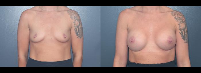 Before & After Breast Augmentation Case 626 Front View in West Des Moines & Ames, IA