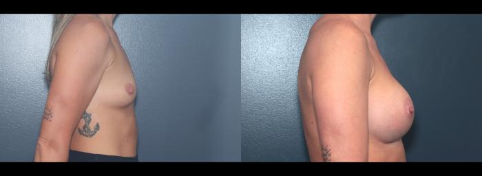 Before & After Breast Augmentation Case 626 Left Side View in West Des Moines & Ames, IA