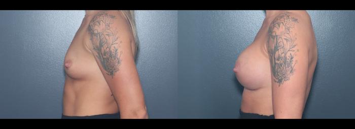 Before & After Breast Augmentation Case 626 Right Side View in West Des Moines & Ames, IA