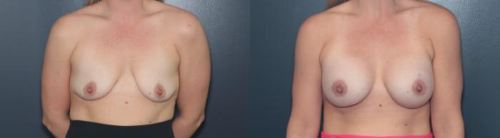 Before & After Breast Augmentation Case 627 Front View in West Des Moines & Ames, IA