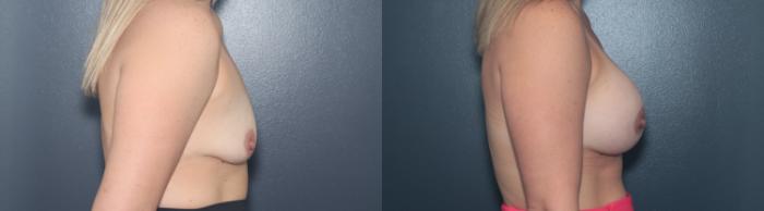 Before & After Breast Augmentation Case 627 Left Side View in West Des Moines & Ames, IA