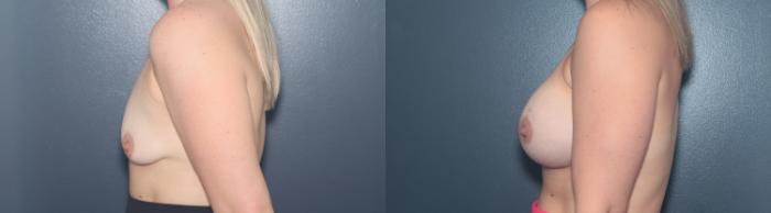 Before & After Breast Augmentation Case 627 Right Side View in West Des Moines & Ames, IA