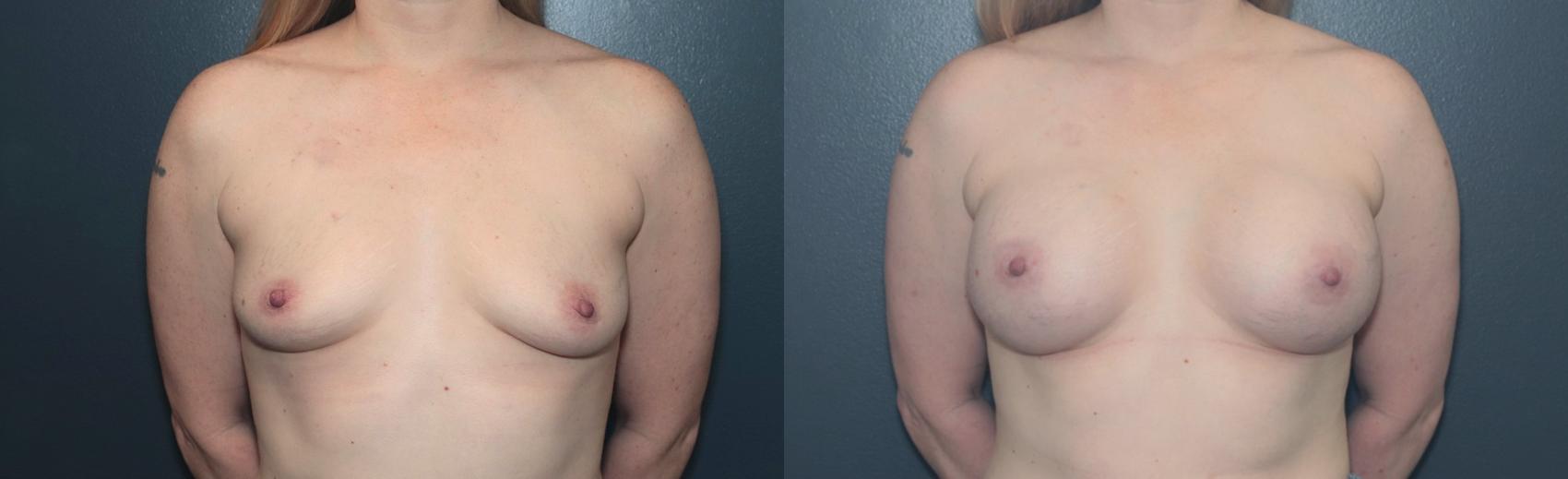 Before & After Breast Augmentation Case 641 Front View in West Des Moines & Ames, IA