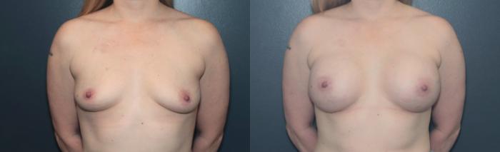 Before & After Breast Augmentation Case 641 Front View in West Des Moines & Ames, IA