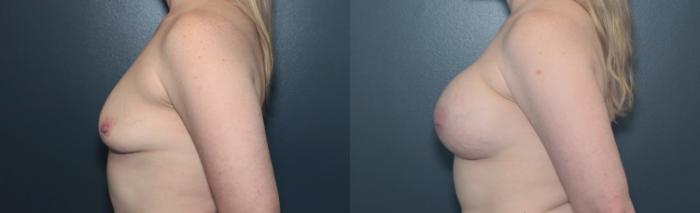 Before & After Breast Augmentation Case 641 Left Side View in West Des Moines & Ames, IA