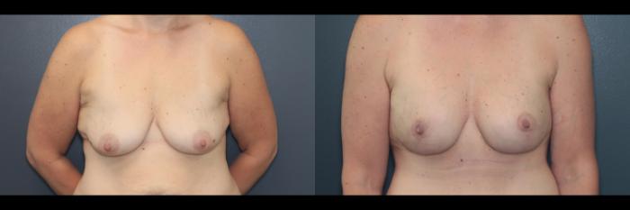 Before & After Breast Augmentation Case 643 Front View in West Des Moines & Ames, IA