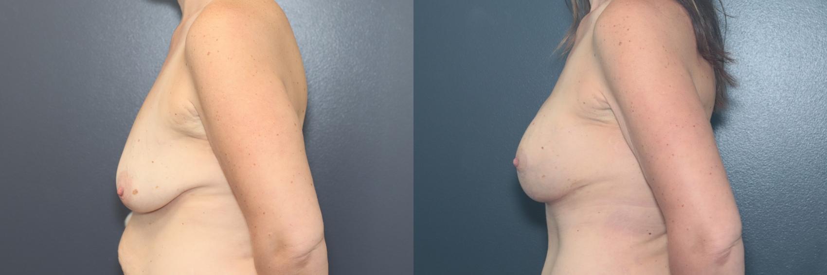 Before & After Breast Augmentation Case 643 Right Side View in West Des Moines & Ames, IA