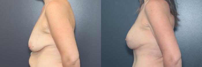 Before & After Breast Augmentation Case 643 Right Side View in West Des Moines & Ames, IA