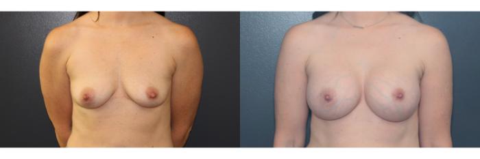 Before & After Breast Augmentation Case 645 Front View in West Des Moines & Ames, IA