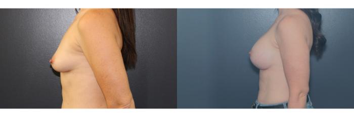 Before & After Breast Augmentation Case 645 Left Side View in West Des Moines & Ames, IA