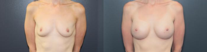Before & After Breast Augmentation Case 646 Front View in West Des Moines & Ames, IA