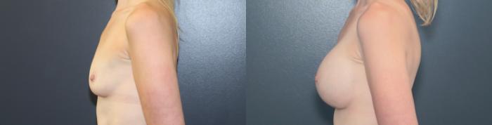Before & After Breast Augmentation Case 646 Right Side View in West Des Moines & Ames, IA