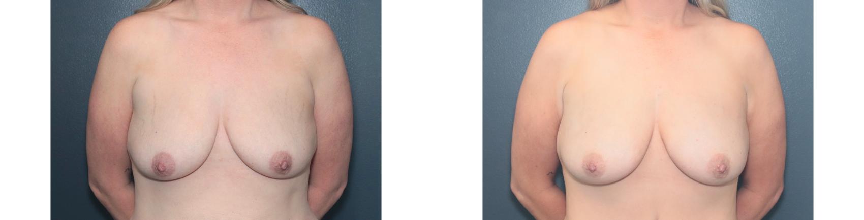 Before & After Breast Augmentation Case 647 Front View in West Des Moines & Ames, IA