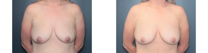 Before & After Breast Augmentation Case 647 Front View in West Des Moines & Ames, IA