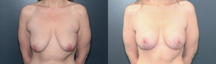 Before & After Breast Augmentation Case 651 Front View in West Des Moines & Ames, IA