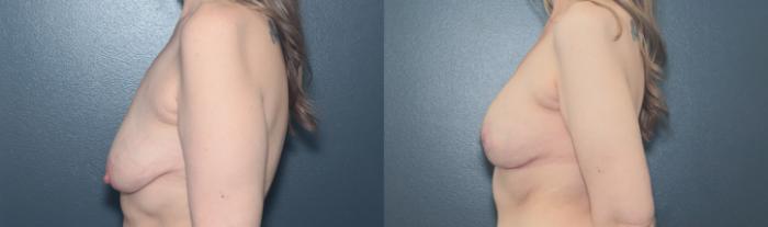 Before & After Breast Augmentation Case 651 Left Side View in West Des Moines & Ames, IA