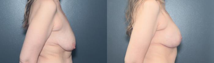 Before & After Breast Augmentation Case 651 Right Side View in West Des Moines & Ames, IA