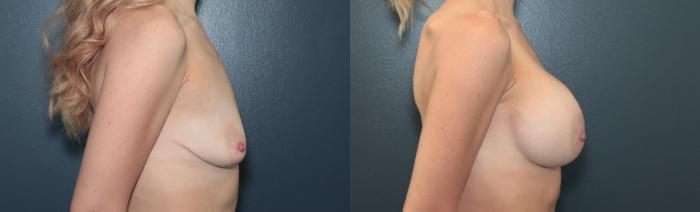 Before & After Breast Augmentation Case 666 Left Side View in West Des Moines & Ames, IA