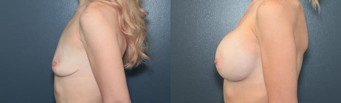 Before & After Breast Augmentation Case 666 Right Side View in West Des Moines & Ames, IA