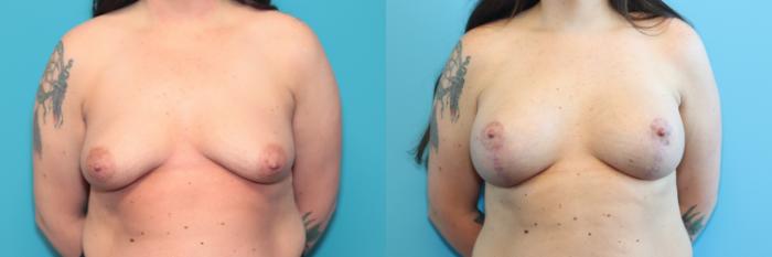 Before & After Breast Lift Case 245 Front View in West Des Moines & Ames, IA