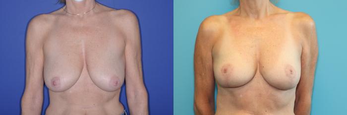 Before & After Breast Lift Case 246 Front View in West Des Moines, IA