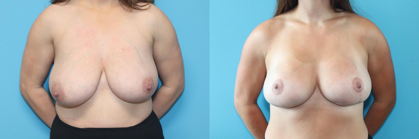 Before & After Breast Lift Case 273 Front View in West Des Moines & Ames, IA