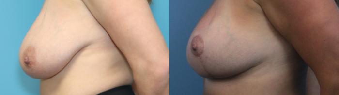 Before & After Breast Lift Case 273 Left Side View in West Des Moines & Ames, IA
