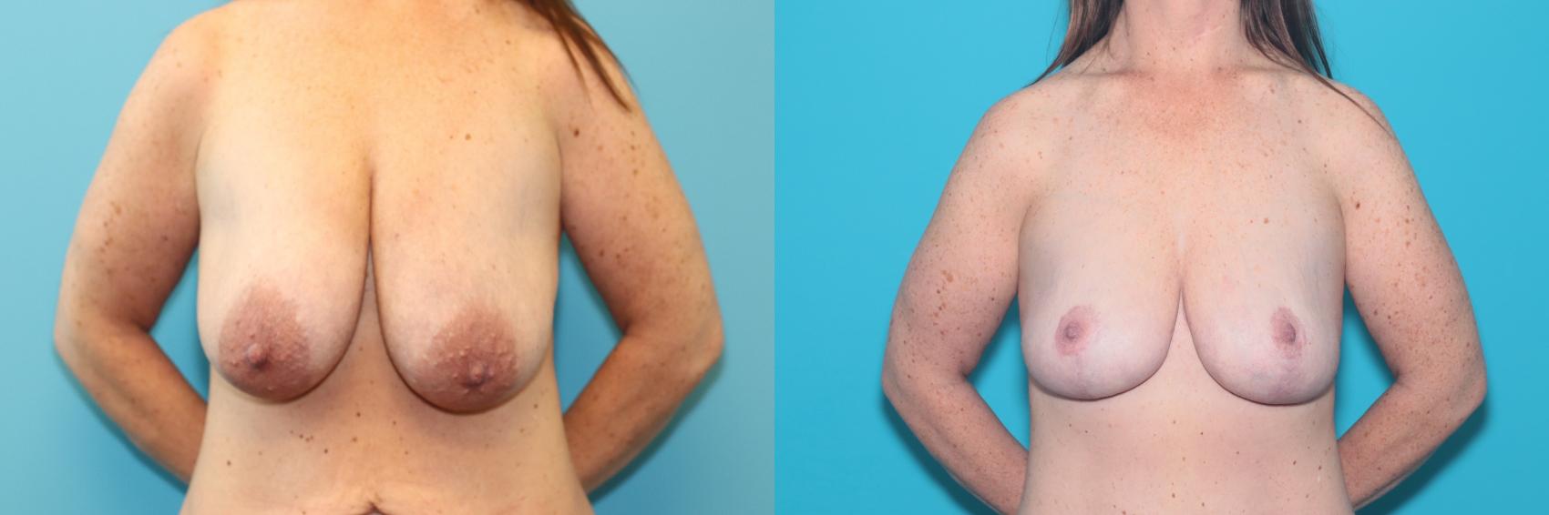 Before & After Breast Lift Case 290 Front View in West Des Moines, IA