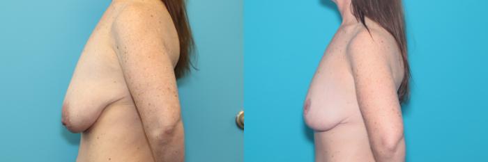 Before & After Breast Lift Case 290 Left Side View in West Des Moines & Ames, IA