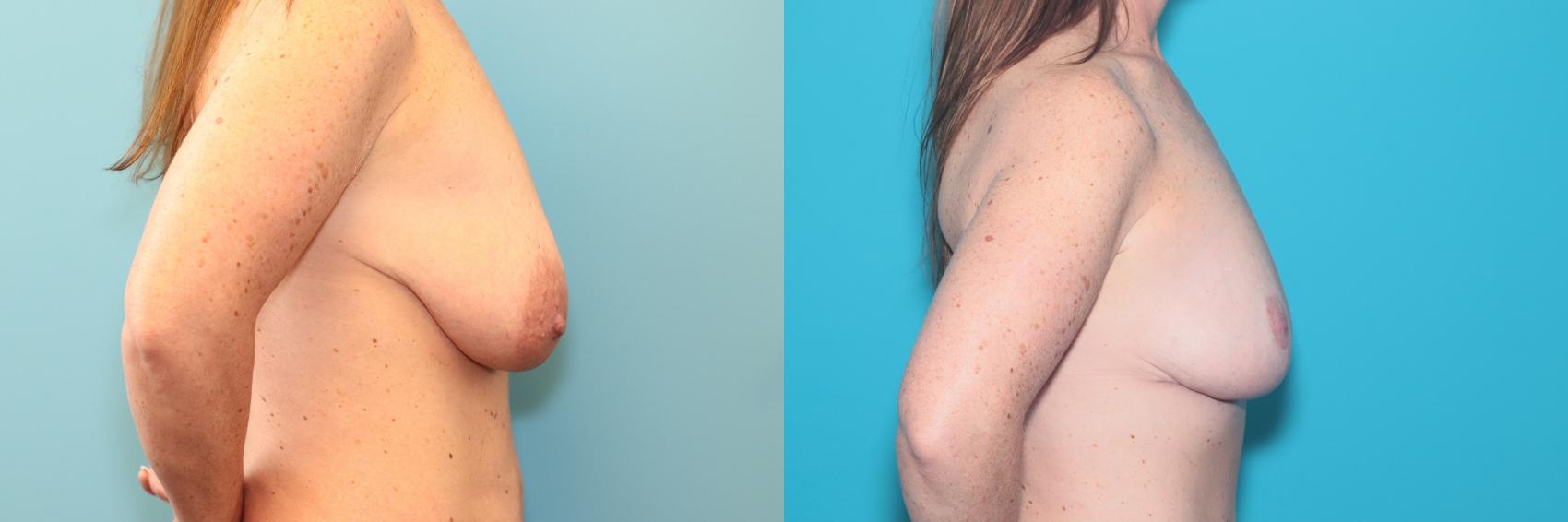 Before & After Breast Lift Case 290 Right Side View in West Des Moines, IA