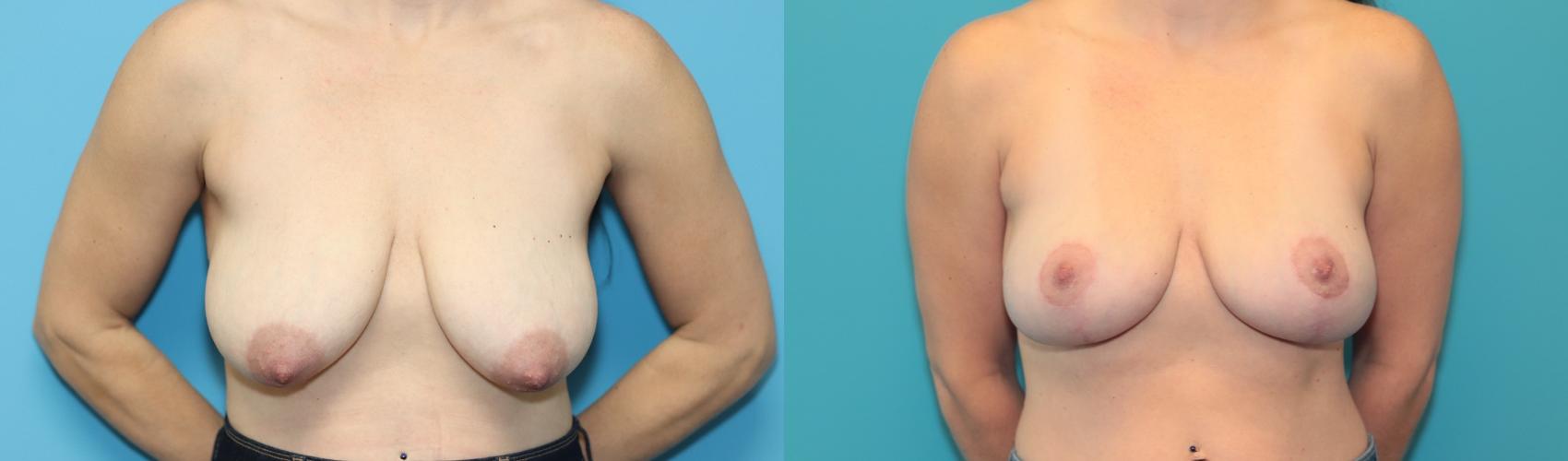 Before & After Breast Lift Case 307 Front View in West Des Moines, IA