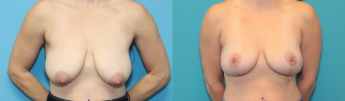 Before & After Breast Lift Case 307 Front View in West Des Moines & Ames, IA