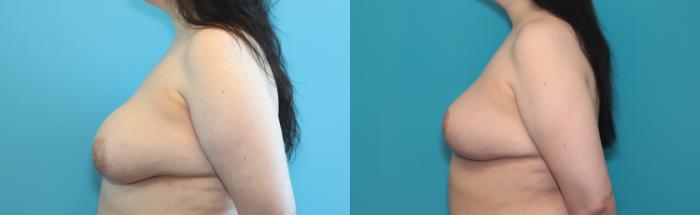 Before & After Breast Lift Case 309 Left Side View in West Des Moines & Ames, IA