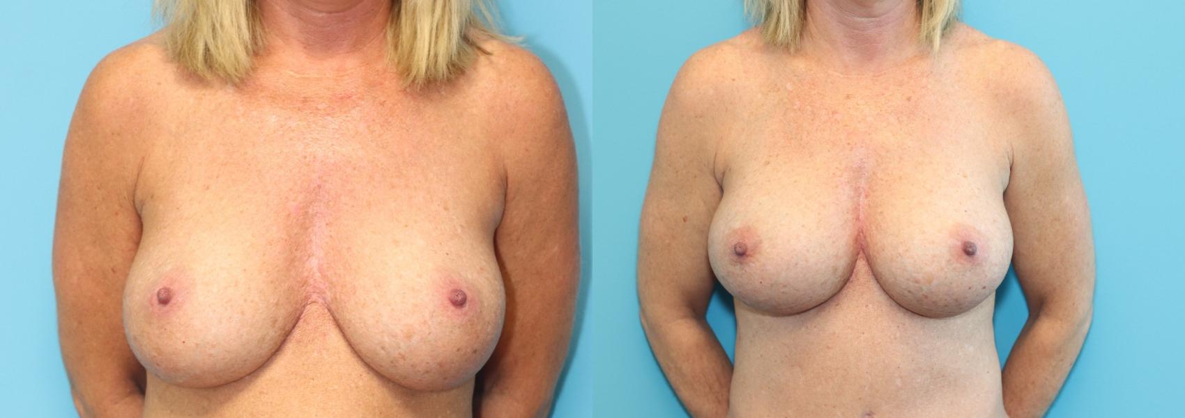 Before & After Breast Lift Case 314 Front View in West Des Moines & Ames, IA