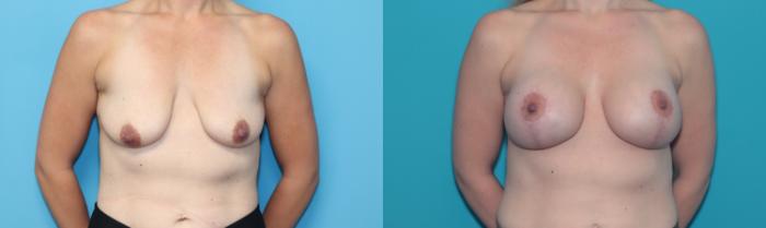 Before & After Breast Augmentation Case 321 Front View in West Des Moines, IA