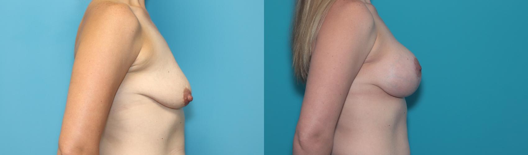 Before & After Breast Lift Case 321 Right Side View in West Des Moines, IA