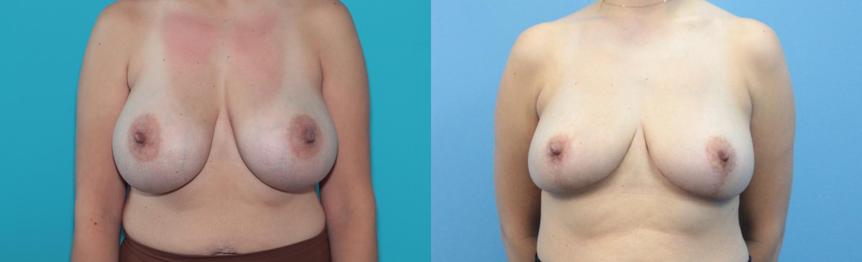 Before & After Breast Lift Case 332 Front View in West Des Moines & Ames, IA