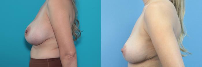 Before & After Breast Lift Case 332 Left Side View in West Des Moines & Ames, IA