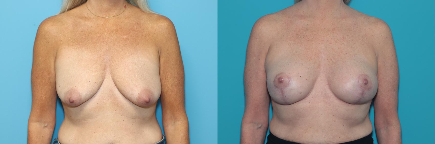 Before & After Breast Lift Case 335 Front View in West Des Moines & Ames, IA