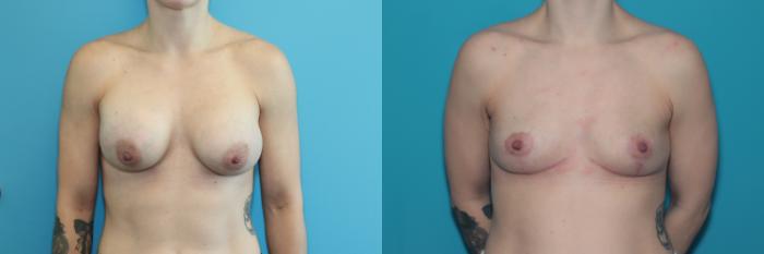 Before & After Breast Lift Case 338 Front View in West Des Moines & Ames, IA