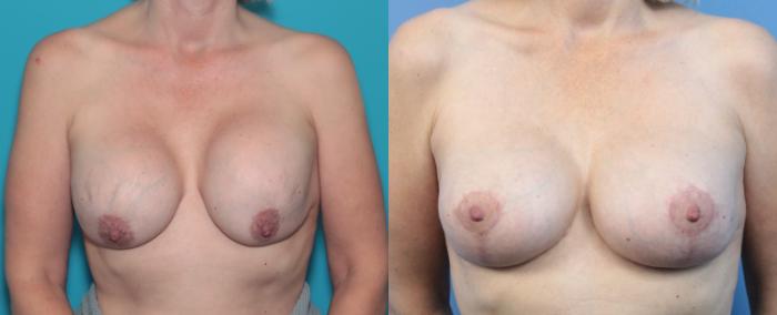 Before & After Breast Lift Case 347 Front View in West Des Moines & Ames, IA