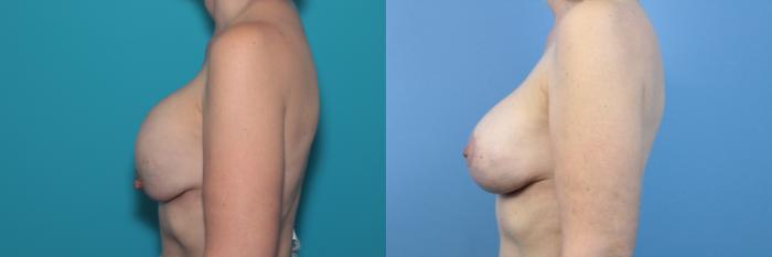 Before & After Breast Augmentation Case 347 Left Side View in West Des Moines & Ames, IA
