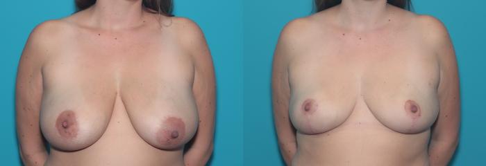 Before & After Breast Lift Case 355 Front View in West Des Moines & Ames, IA