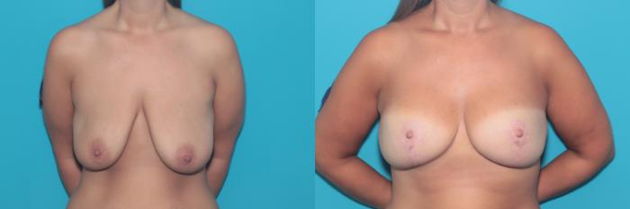 Before & After Breast Lift Case 361 Front View in West Des Moines & Ames, IA